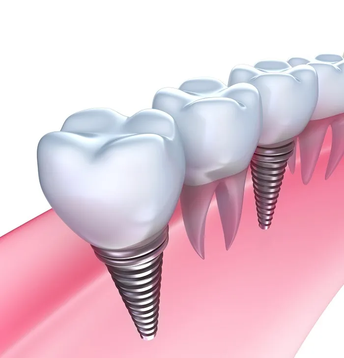 KAZZ dental clinicの考える「インプラント」とは
