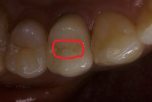 虫歯の好発部位