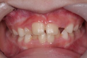 子供の歯並びが悪くなる原因