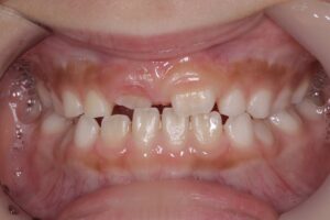 自分の歯並びが悪いので、娘も歯並びは悪くなりますか？