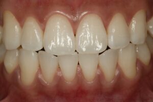 奥歯と前歯の機能