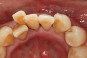 歯並びが悪いと歯周病になりますか？