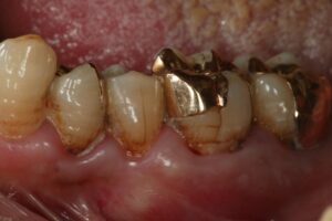 どうして虫歯になると歯が痛くなるのですか？