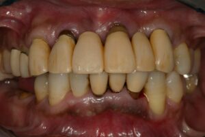 歯周病は遺伝する？