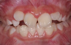 歯並びが悪いと何か影響はありますか？