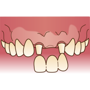 歯が抜けてしまった時の治療方法は何がありますか？
