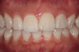 なぜホワイトニングで歯が白くなるの？